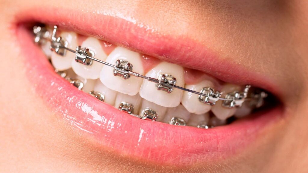 Gros plan de bagues sur les dents